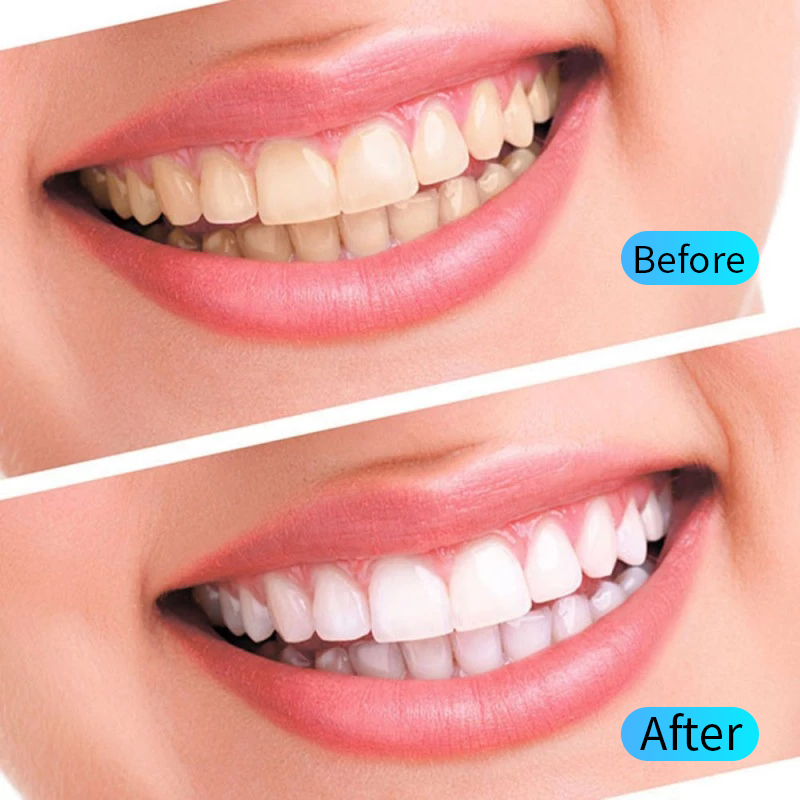 Teeth Whitening Gel Kit Oral H - Teeth Whitening Filter 리뷰 및 가격
