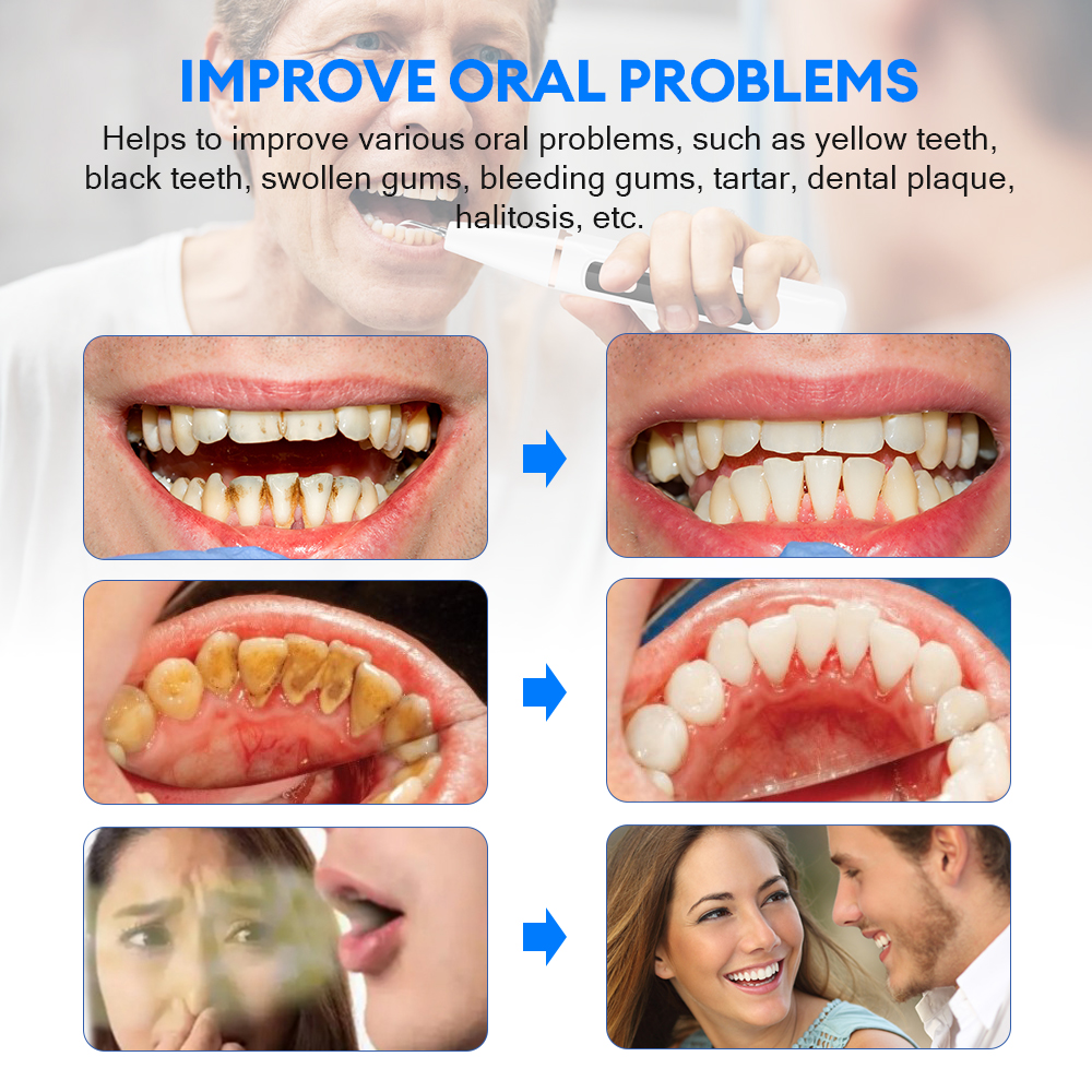 Electric Ultrasonic Dental Sca - Teeth Whitening Professional 리뷰 및 가격