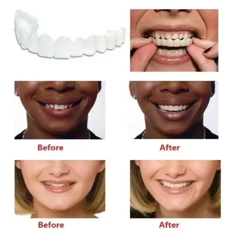 Teeth Veneers Whitening Dentur - Teeth Whitening Kit 리뷰 및 가격