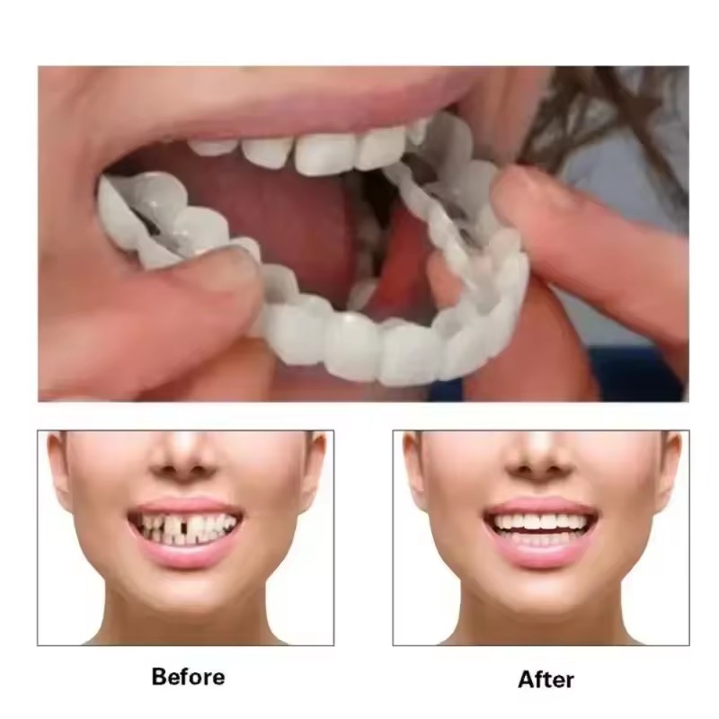 Teeth Veneers Whitening Dentur - Teeth Whitening Kit 리뷰 및 가격